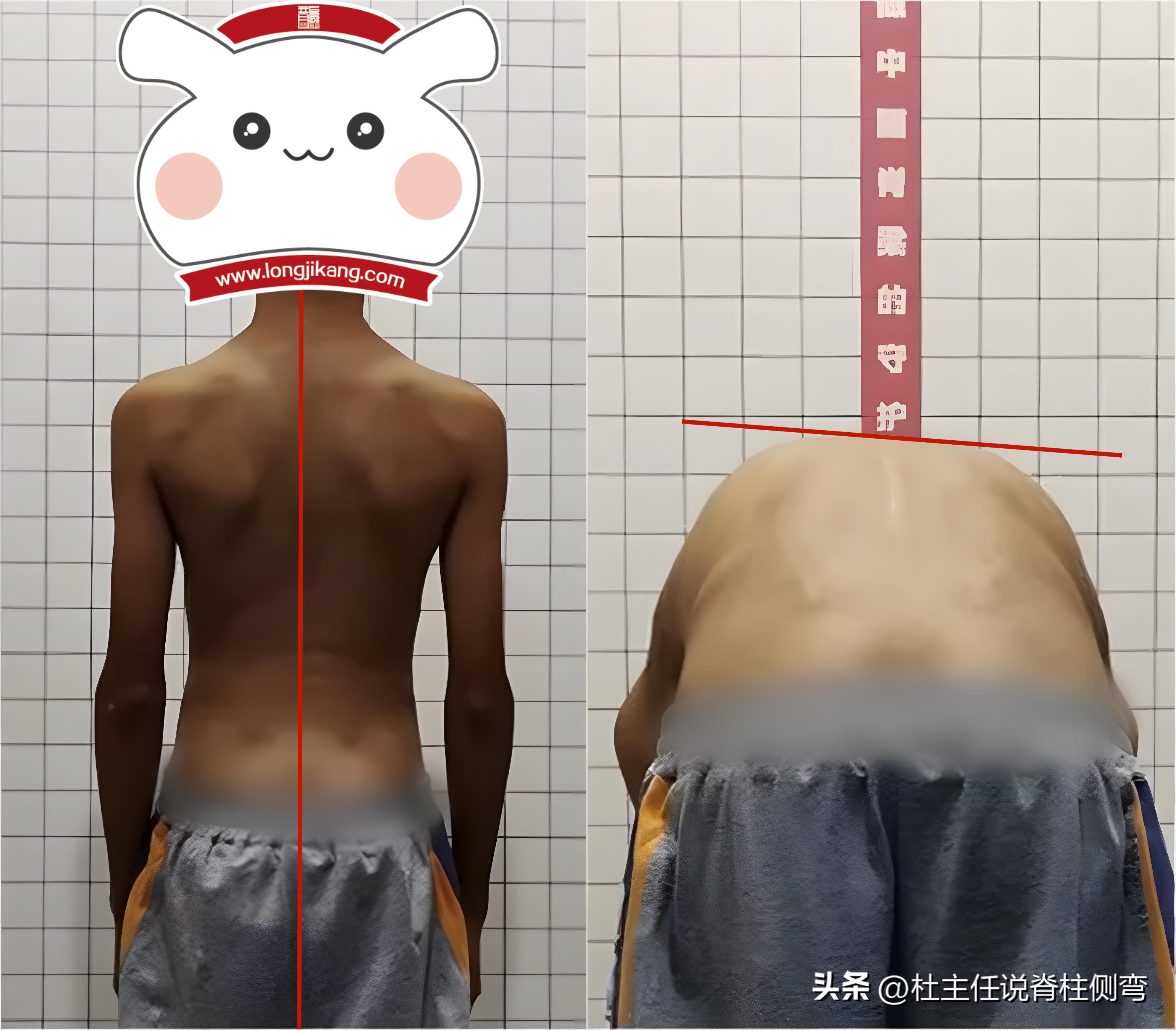 脊柱侧弯十几度有必要戴支具,17岁女孩脊柱侧弯需要佩戴支具吗