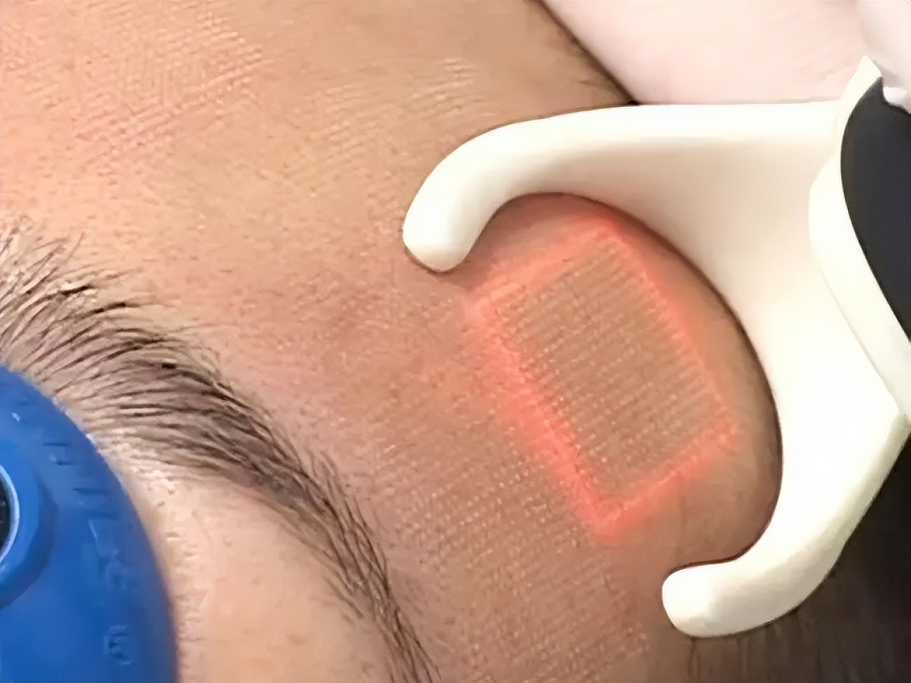 痘痘痘印痘坑改善全过程,学生祛痘痘和痘印痘坑简单的方法