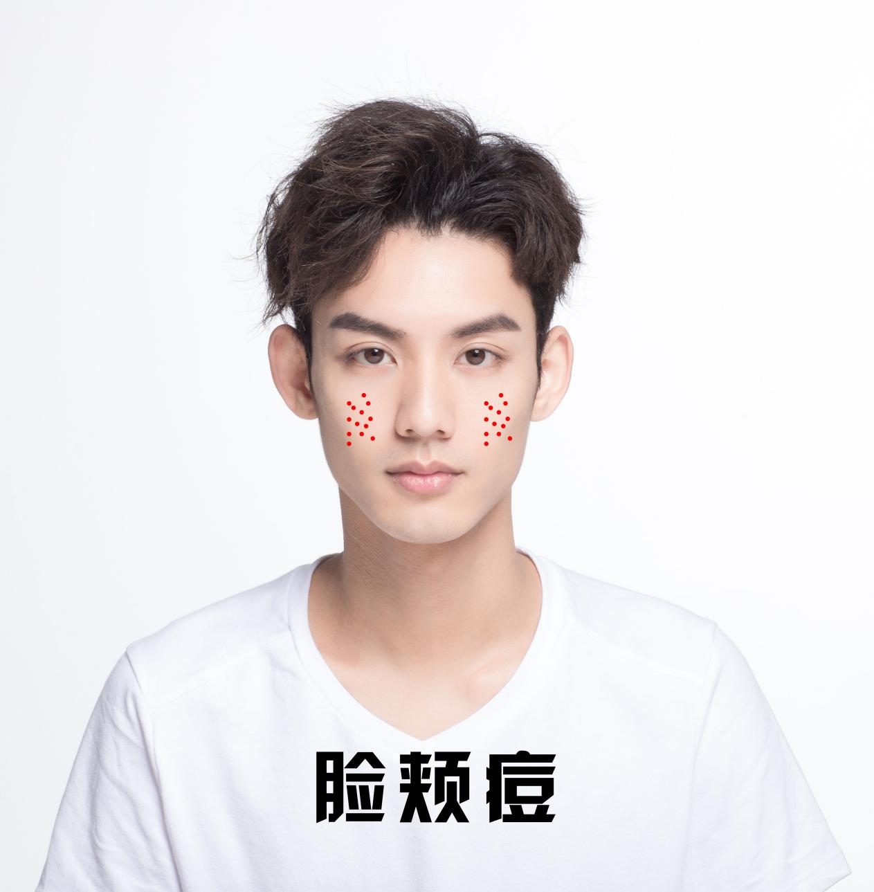 祛痘攻略图文,全网最好用的祛痘方法