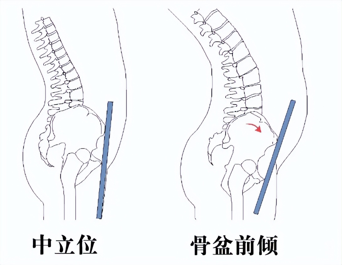 屁股太翘是什么病,屁股翘的病
