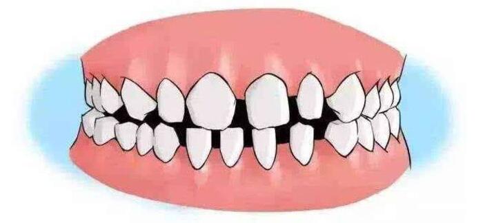 牙缝大怎么补,牙缝大可不可以修补