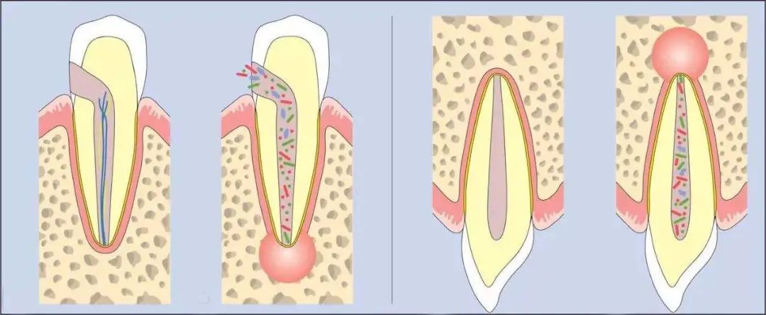 牙疼得要命会自愈吗,牙疼硬抗多久能把牙神经扛过去
