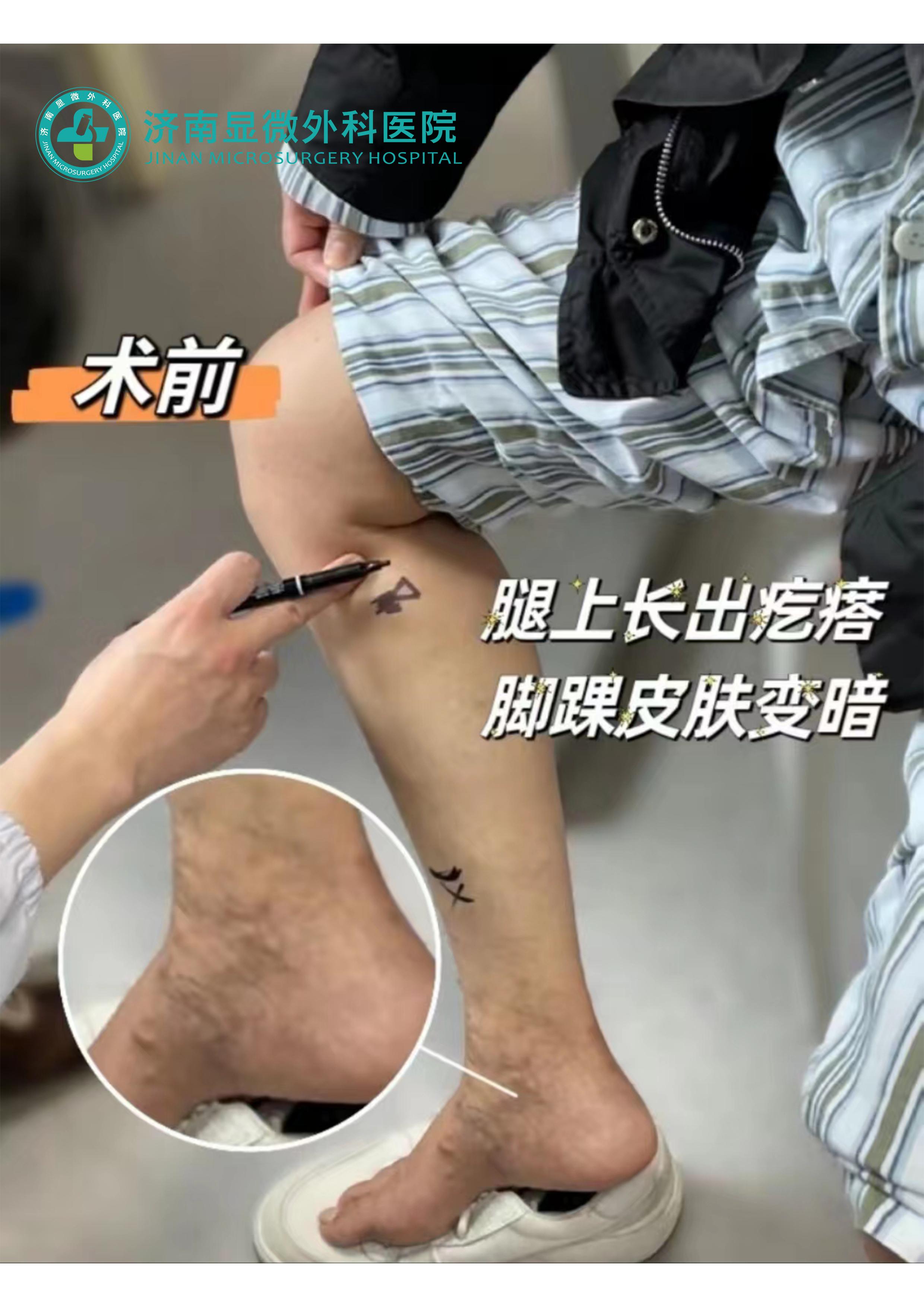 静脉曲张杨医生,静脉曲张微创手术导管消融