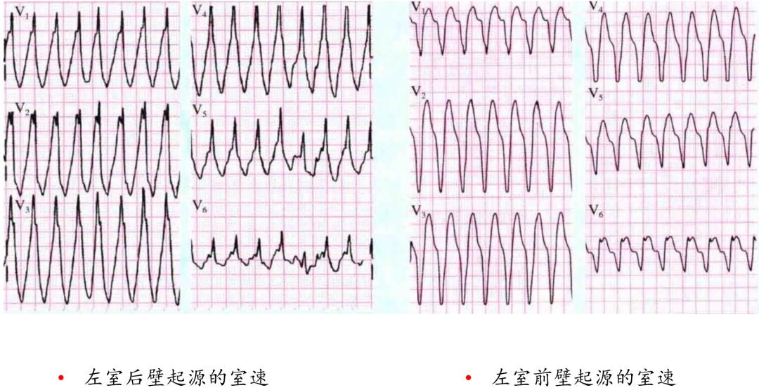 心电图上表现为宽qrs波,心电图中qrs是代表心动过速吗