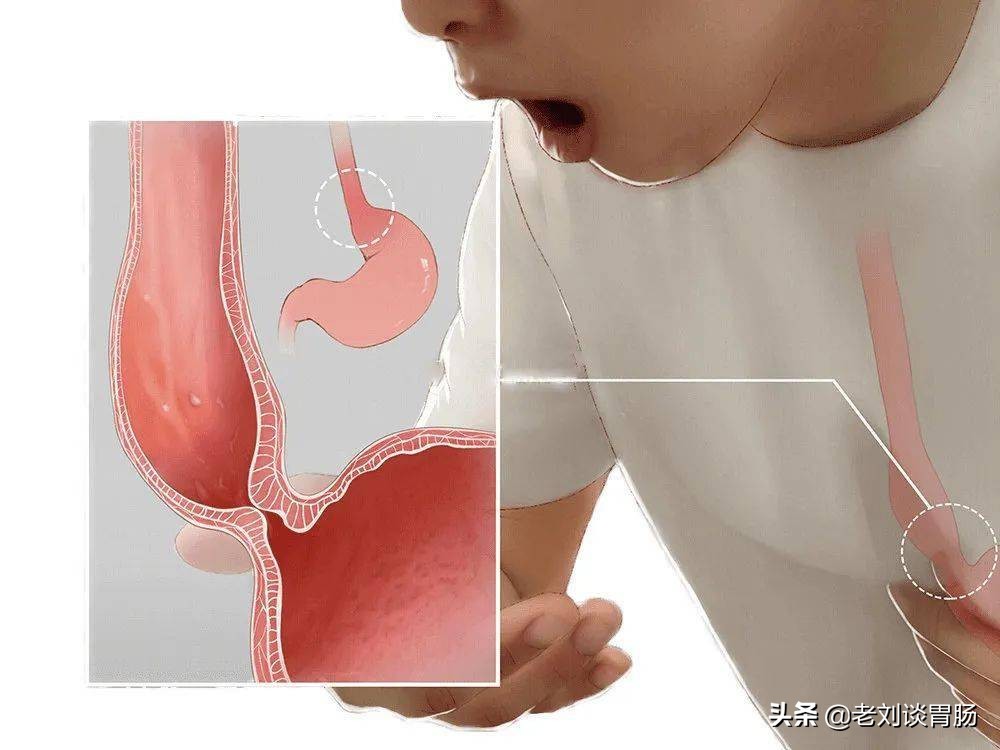 贲门失弛缓症什么引起的,贲门失弛缓症是什么原因引起的