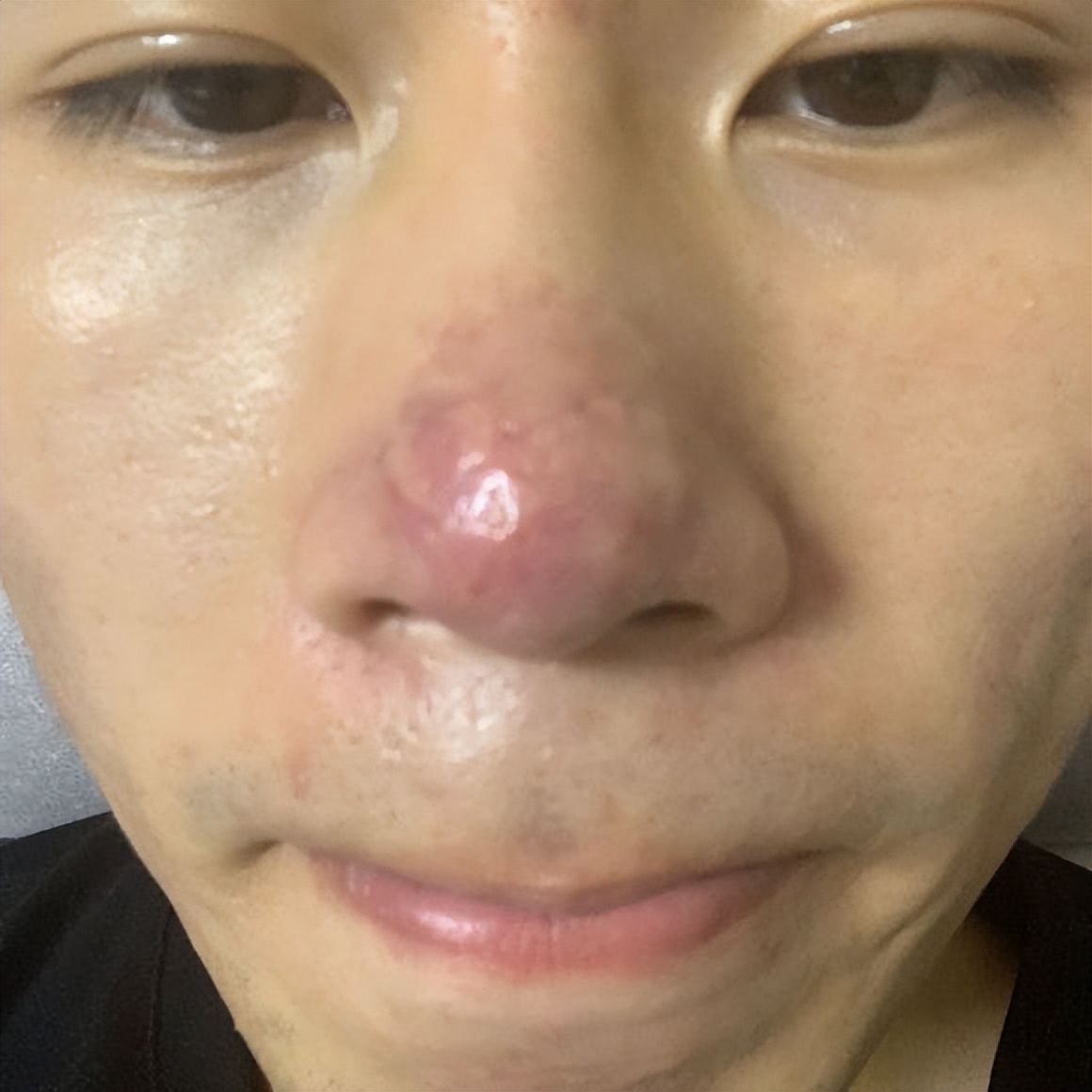 鼻子上油脂粒去除后怎么收缩毛孔,鼻子上长了个类似痘的东西