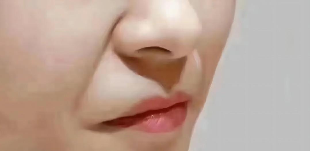 怎样消除法令纹不同部位,不同类型的法令纹应该如何消除