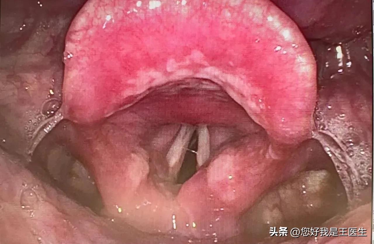 脾胃虚寒咳嗽有白痰吃哪些中成药,胸闷气短咳嗽有白痰吃什么中成药