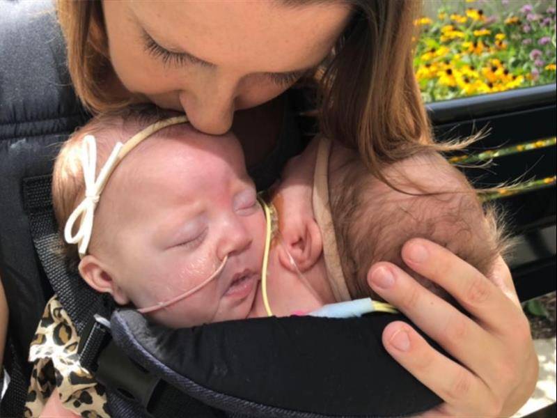 连体姐妹一人结婚现在如何,雌雄连体人结婚怎么办