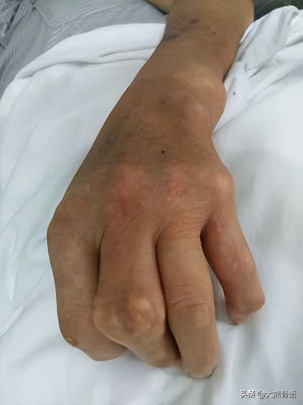 手指痛风的初期症状和治疗,脚踝痛风的症状和治疗方法