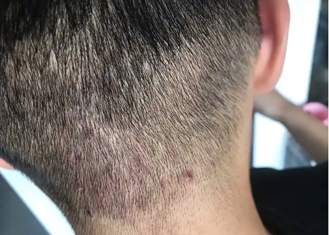 头皮上摸到一个硬疙瘩,头皮有小疙瘩摸着疼怎么回事