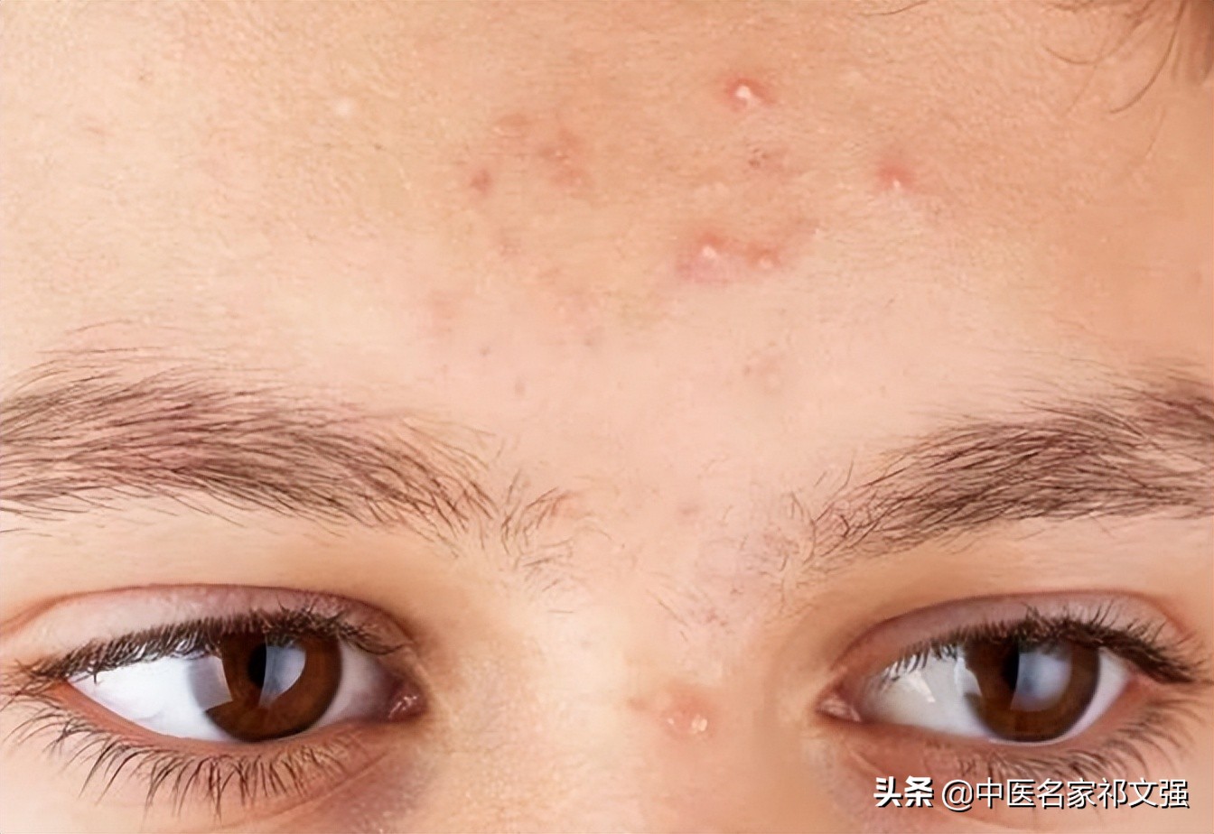 中医治脓疮偏方,火钳子疮中医治法