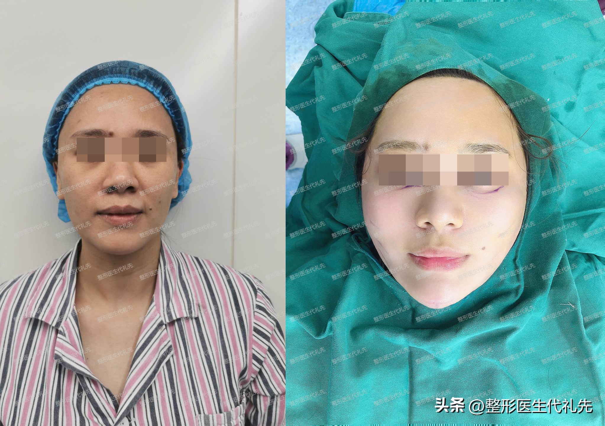 脂肪填充苹果肌刚填充的效果,填充苹果肌用什么填充