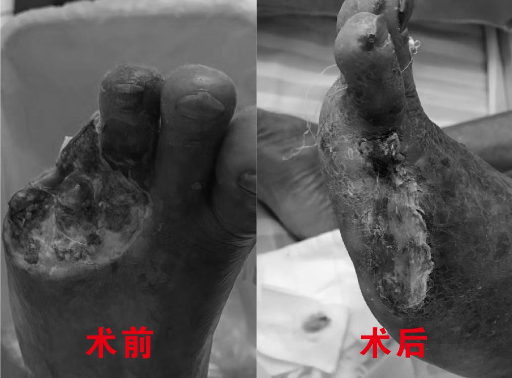 糖尿病足小发明,胫骨皮瓣移植治疗糖尿病足