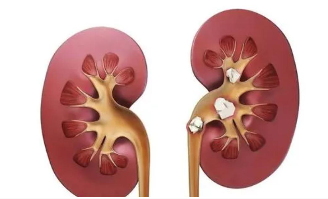 空腹吃柿子为什么会结石,空腹食用柿子当心结石作怪