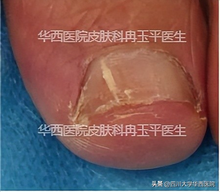 灰指甲是指甲发灰吗,指甲灰色就是灰指甲吗