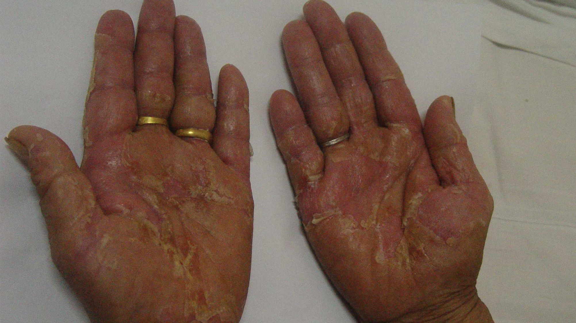 乳腺化疗后指甲盖红肿,乳房一会疼一下怎么回事