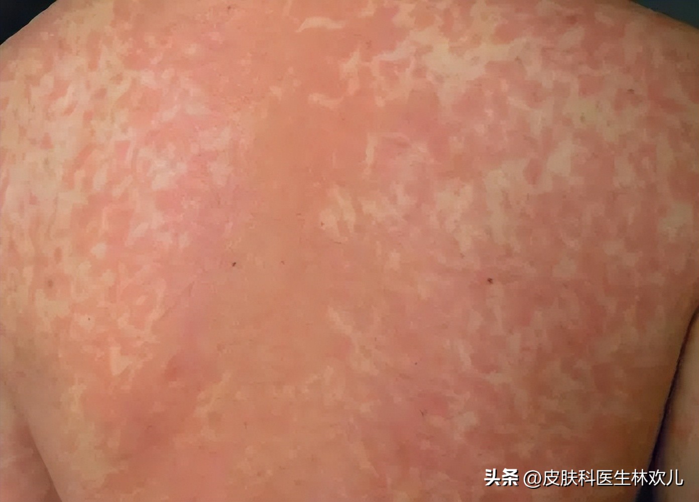 新冠期间皮肤瘙痒红斑咋回事,新冠皮肤痒怎么回事