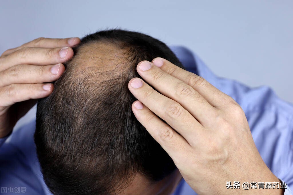 脱发治疗需要花费多少钱,脱发怎么治疗最省钱