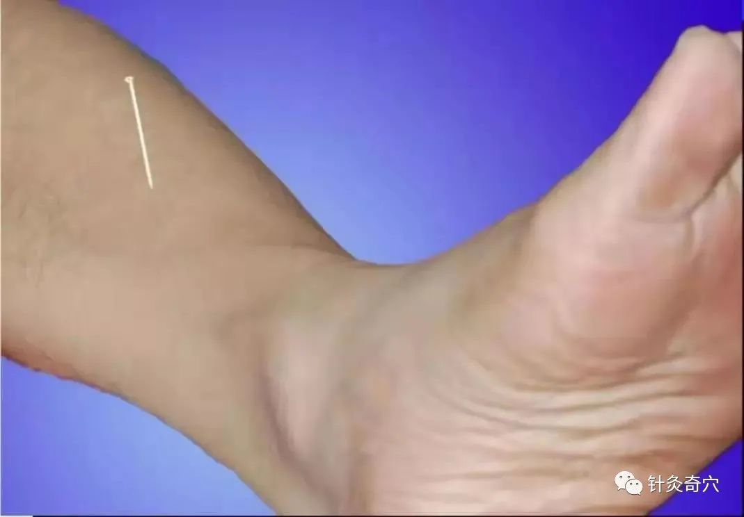 史上最全中医针灸视频教程全集,针灸治疗真实图片大全