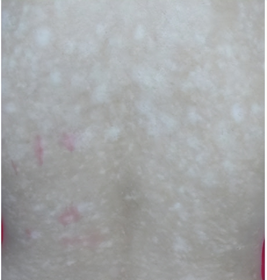 皮肤色素减退和白癜风有什么区别,白癜风是不是色素性皮肤病