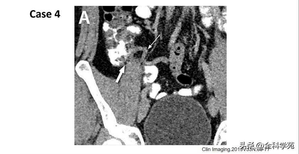 阑尾炎的讲解,关于阑尾炎的讨论总结