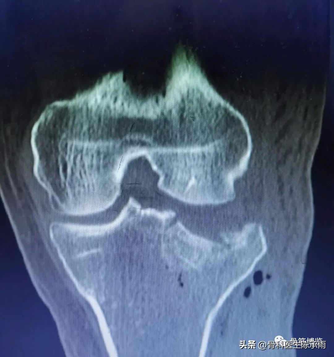 膝关节胫骨平台骨折,最近胫骨平台骨折视频