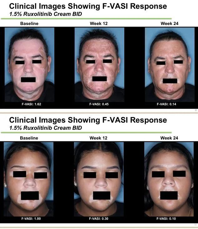 @冯导，白癜风治疗有新药了，显著改善面部全身白癜风