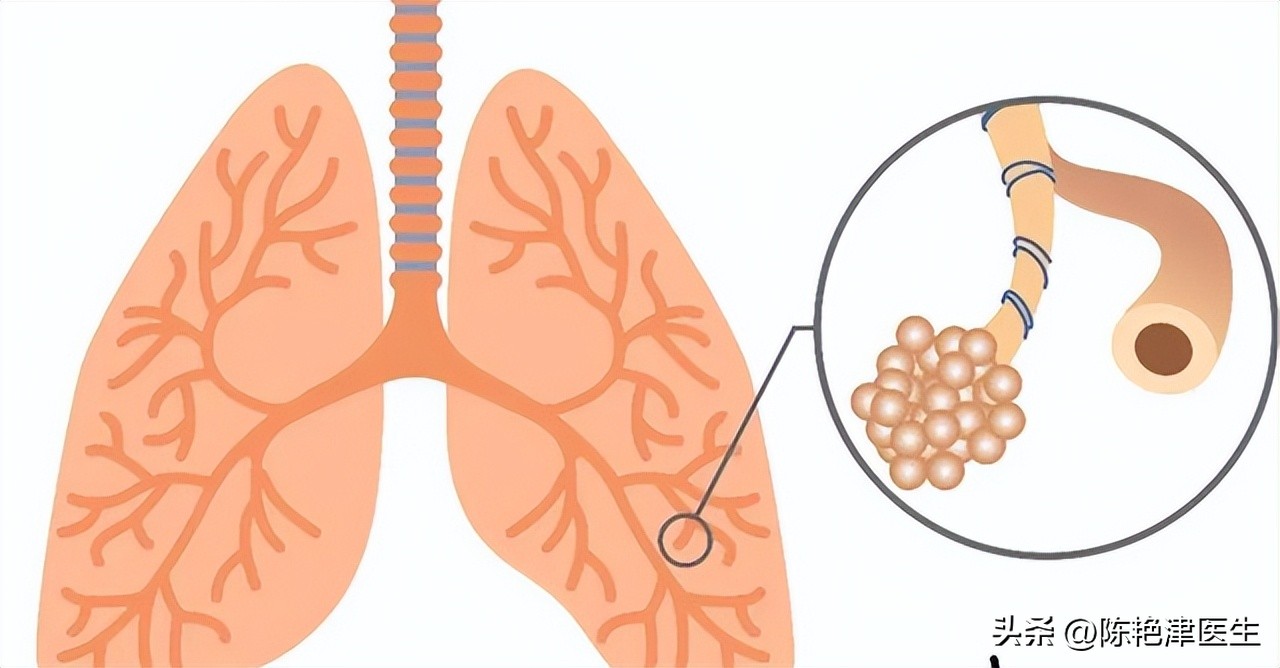 为什么医生不肯说肺大泡有多大,体检肺大疱是什么意思