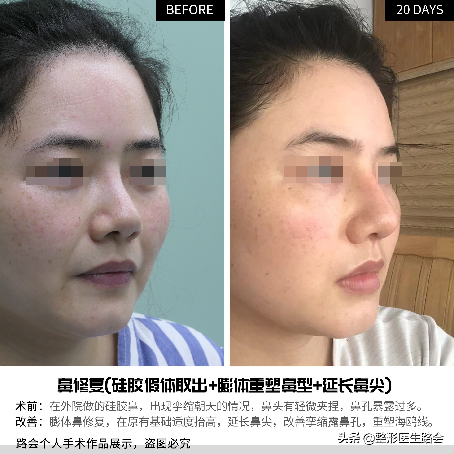 硅胶隆鼻5年歪了怎么修复,隆鼻10天歪了可以矫正吗