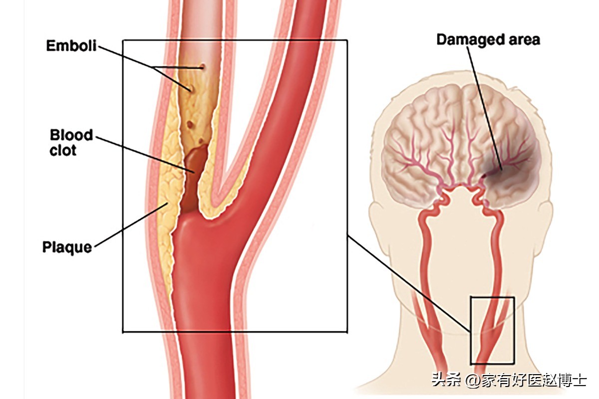 iwatch怎么预防心梗脑梗,张之瀛大夫如何预防心梗和脑梗