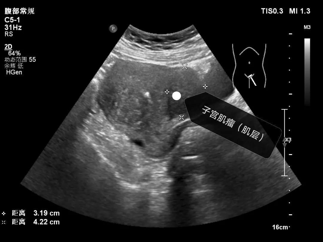 子宫肌瘤是怎么患上的,得了子宫肌瘤该如何是好