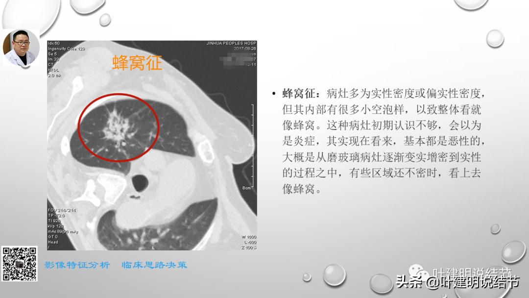 在《一脉阳光》呼吸影像诊断专题培训班上的讲课PPT（第一部分）