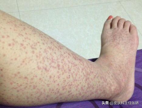 过敏性紫癜是怎样的病,过敏性紫癜怎样治疗才能断根