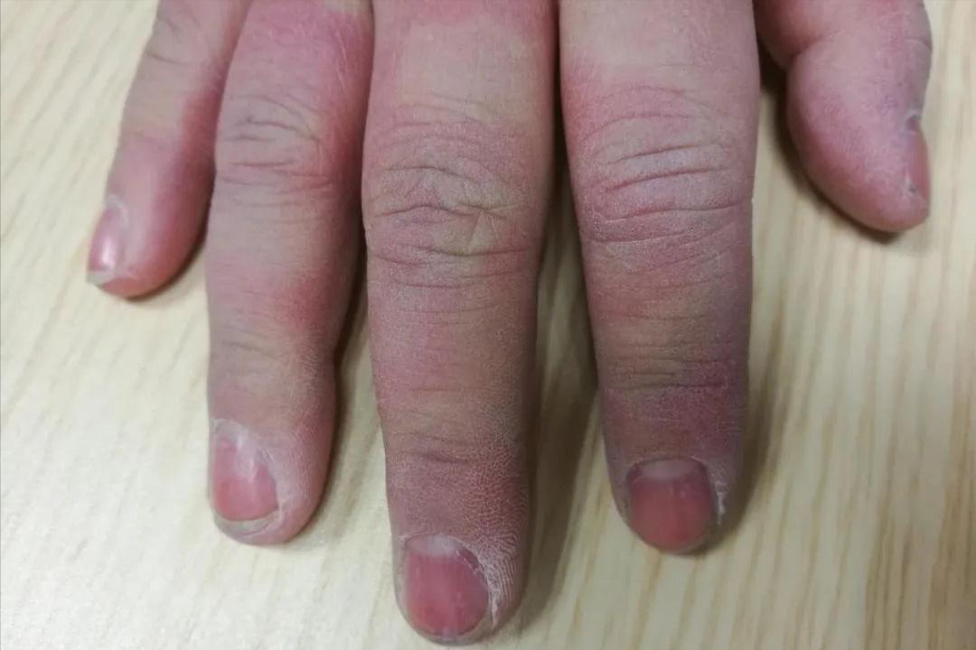 嵌甲疼痛难忍,嵌甲怎么才能有效缓解疼痛