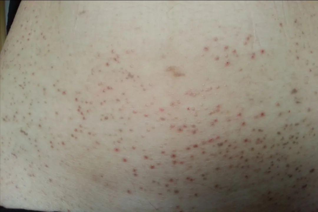 hpv病毒引起的疣是什么,hpv引起的病毒疣