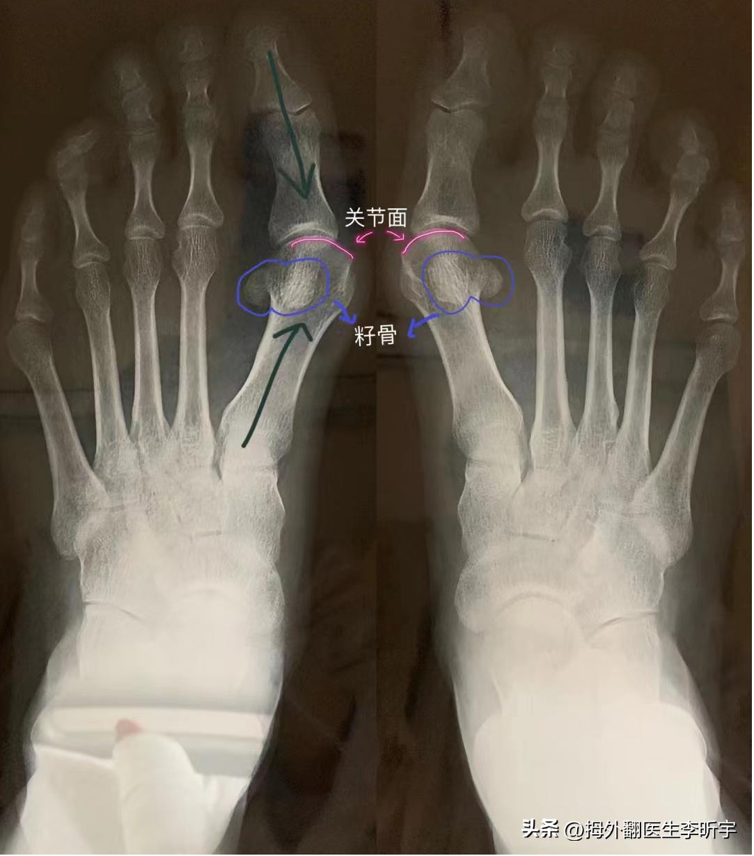 拇外翻矫正器真的有用吗,拇指外翻矫正器是智商税吗