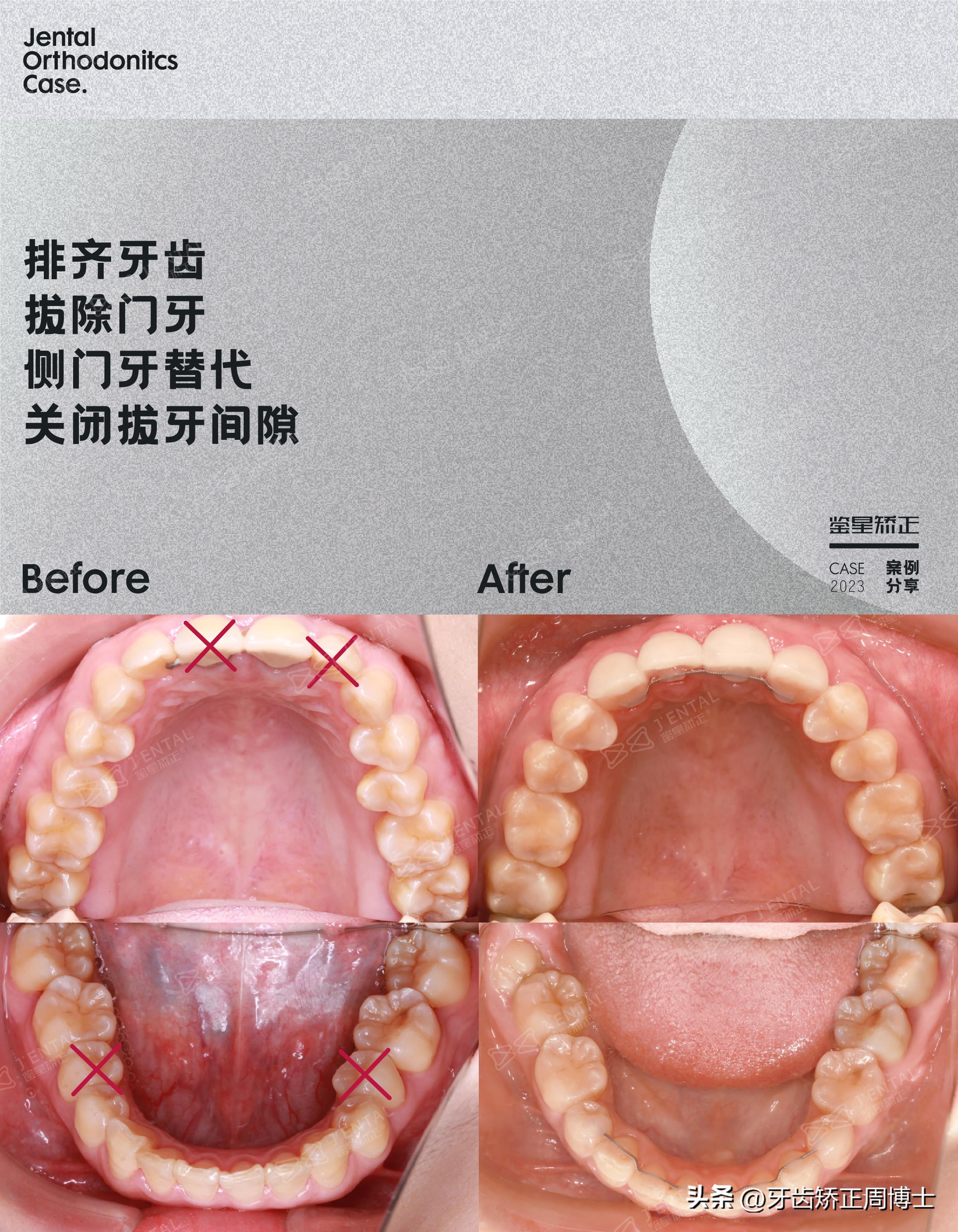 骨性前突下巴后缩可以矫正吗,上颌骨前突下巴后缩如何矫正