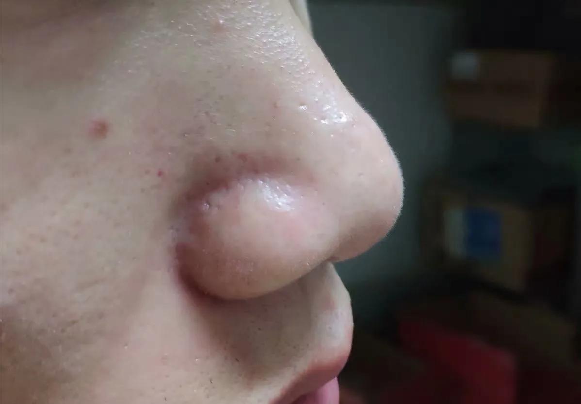 去鼻子上的黑头最好的方法,去鼻子上黑头的有效方法