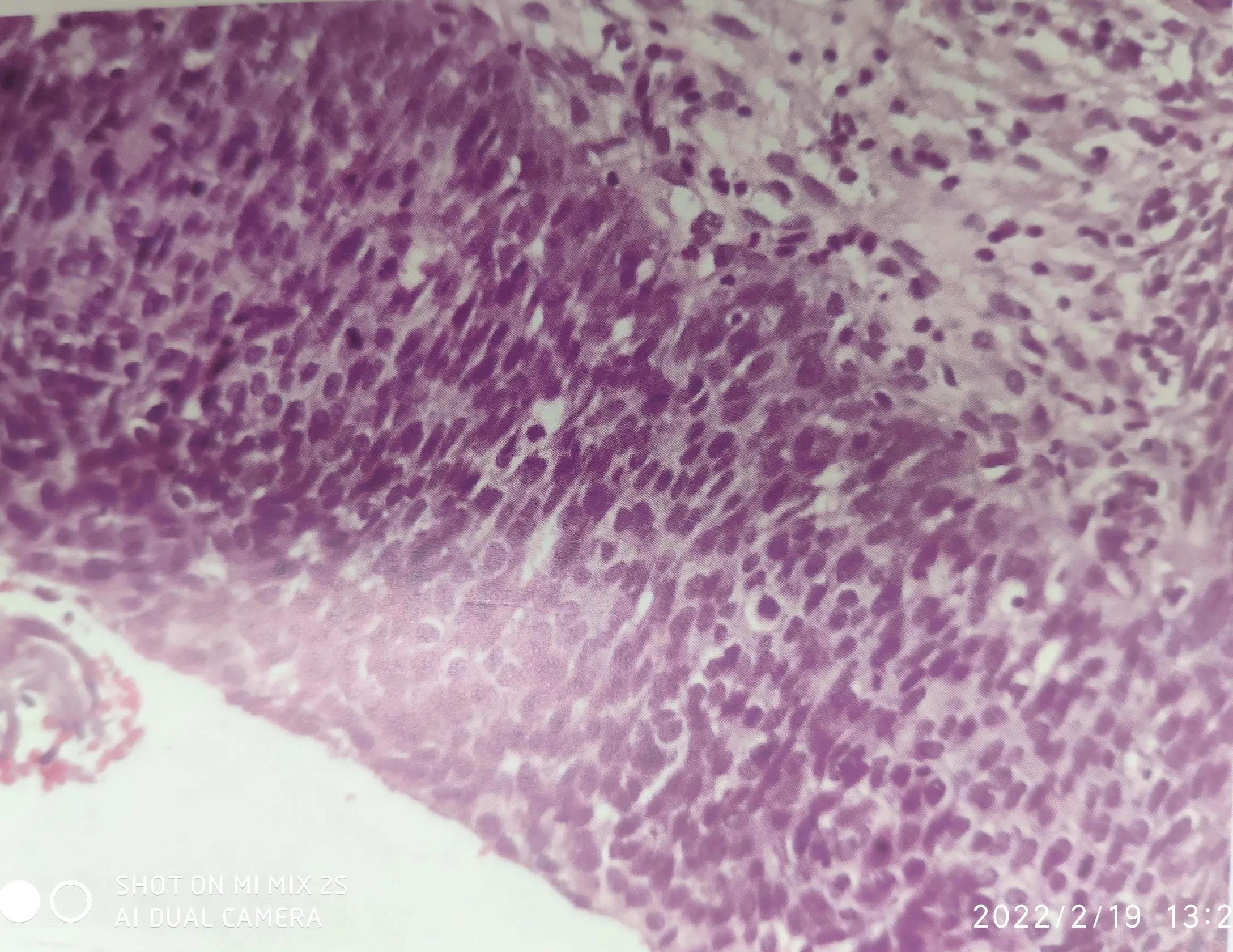 病理报告上“宫颈CIN”危险吗？会不会变癌？