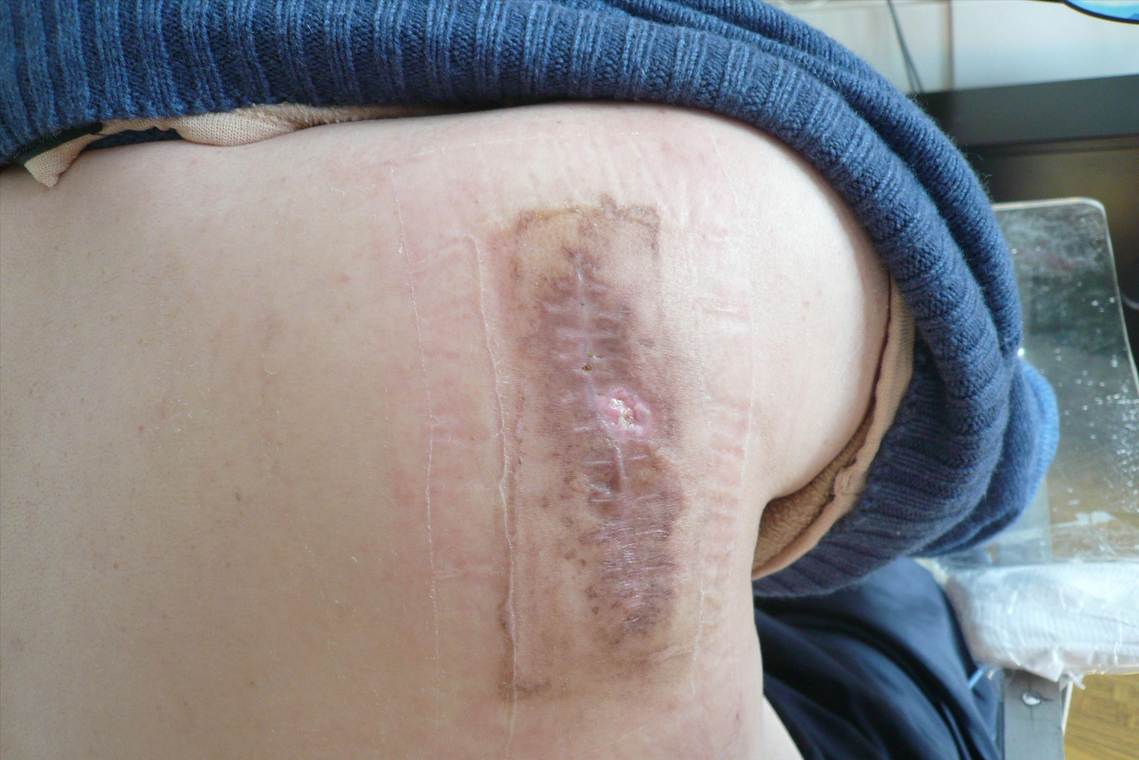 疤痕治疗在医药费赔偿范围内吗,疤痕治疗费用有纳入医保吗