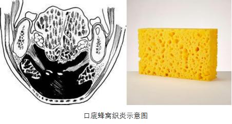 一颗智齿要了命,一颗智齿发炎