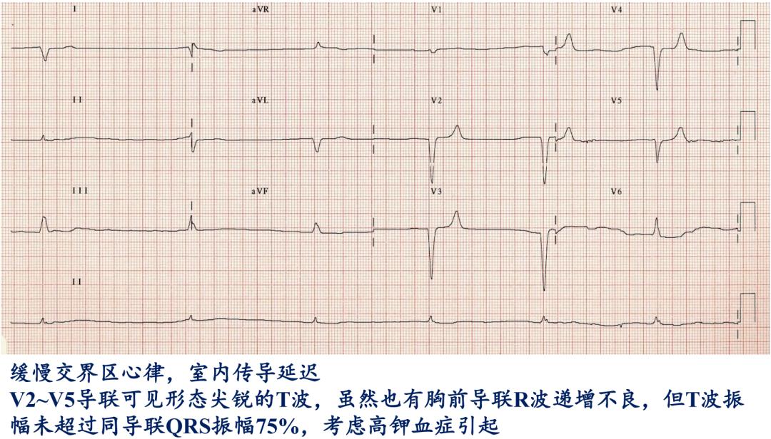 t波高尖心电图判断标准,t波高尖判断标准