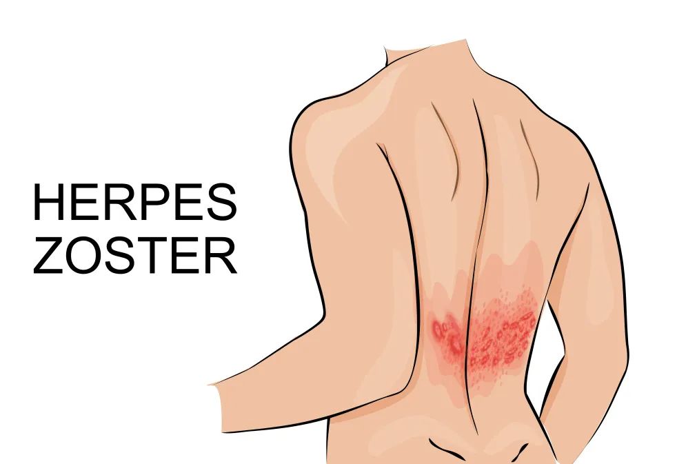 蛇缠腰带状疱疹好了能打疫苗吗,蛇缠腰特效疫苗