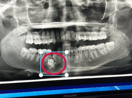 成年人患上牙瘤从牙里拔出57颗牙,一女生患牙瘤拔掉57颗牙