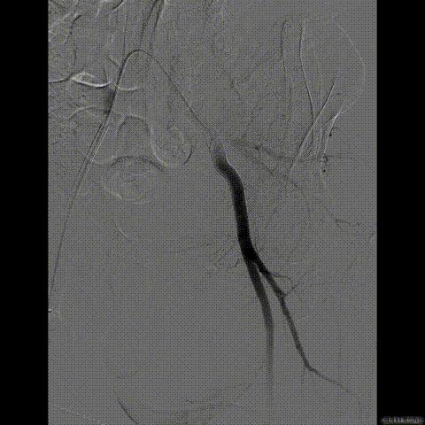 病例回顾与分享,腹膜后血肿介入治疗