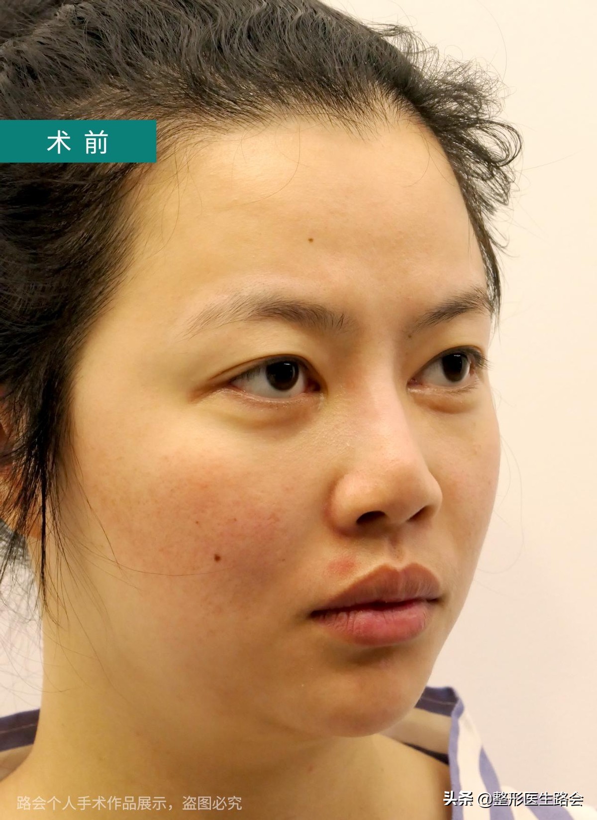 隆鼻失败鼻头有个坑的原因,隆鼻失败导致的鼻头凹陷怎么修复