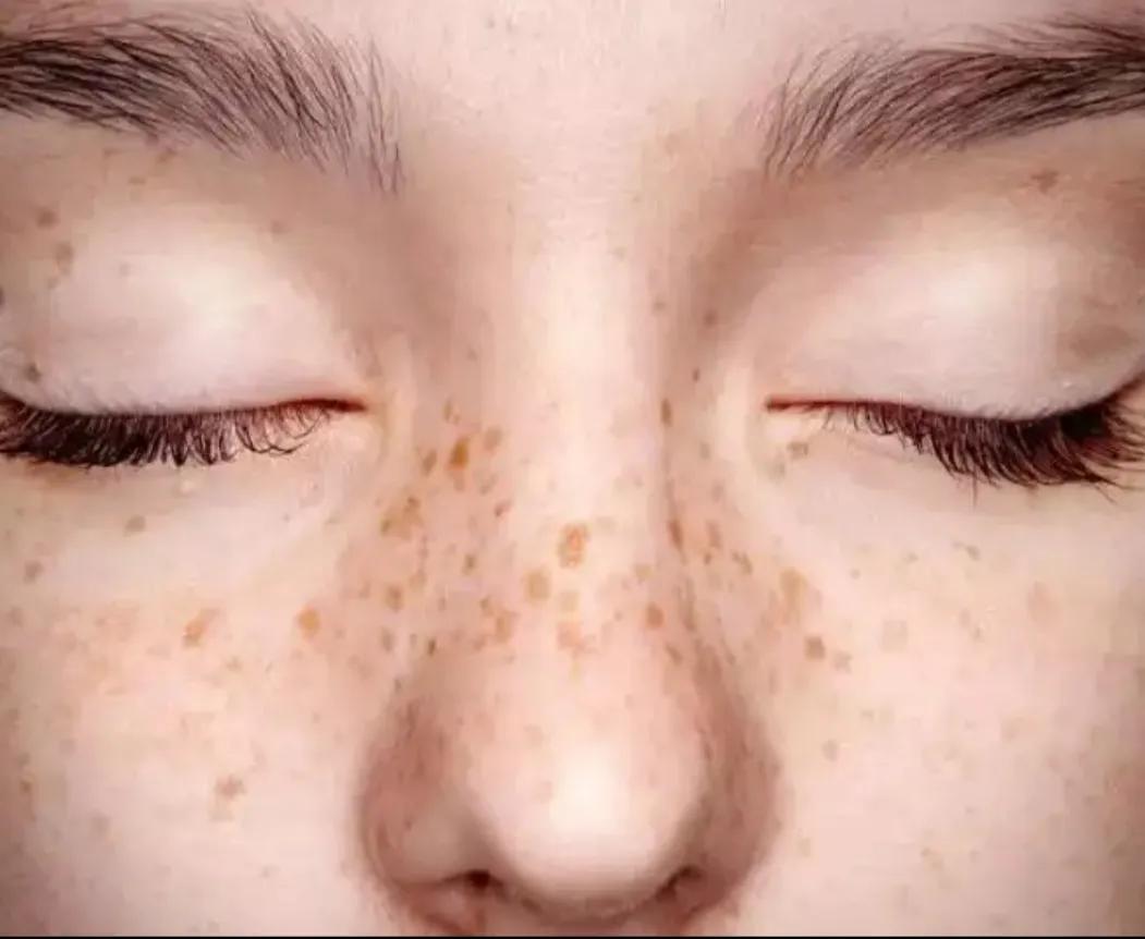 40多岁脸上长黑点是什么斑,40岁脸上长斑用什么护肤品