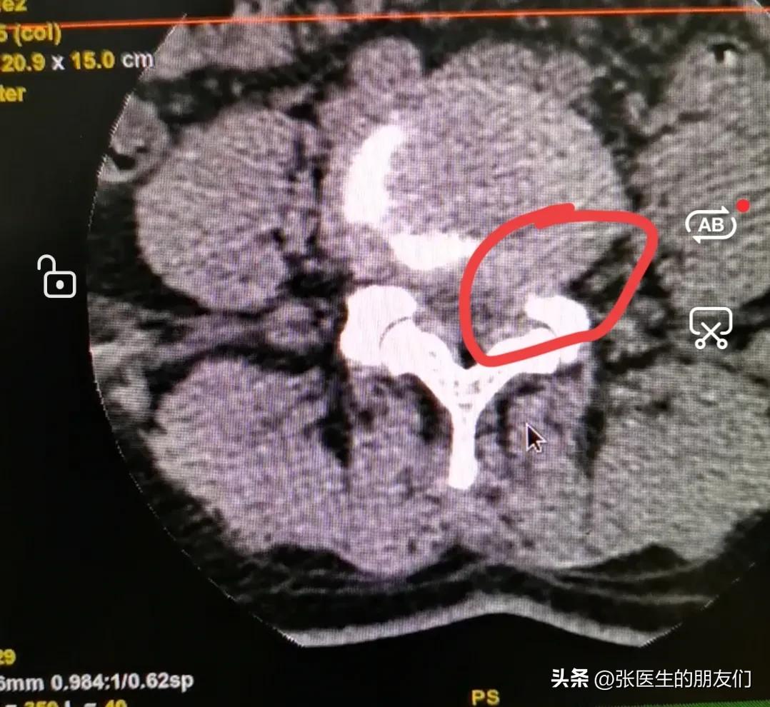 腰椎间盘突出十天治好,腰椎间盘突出保守治疗10年