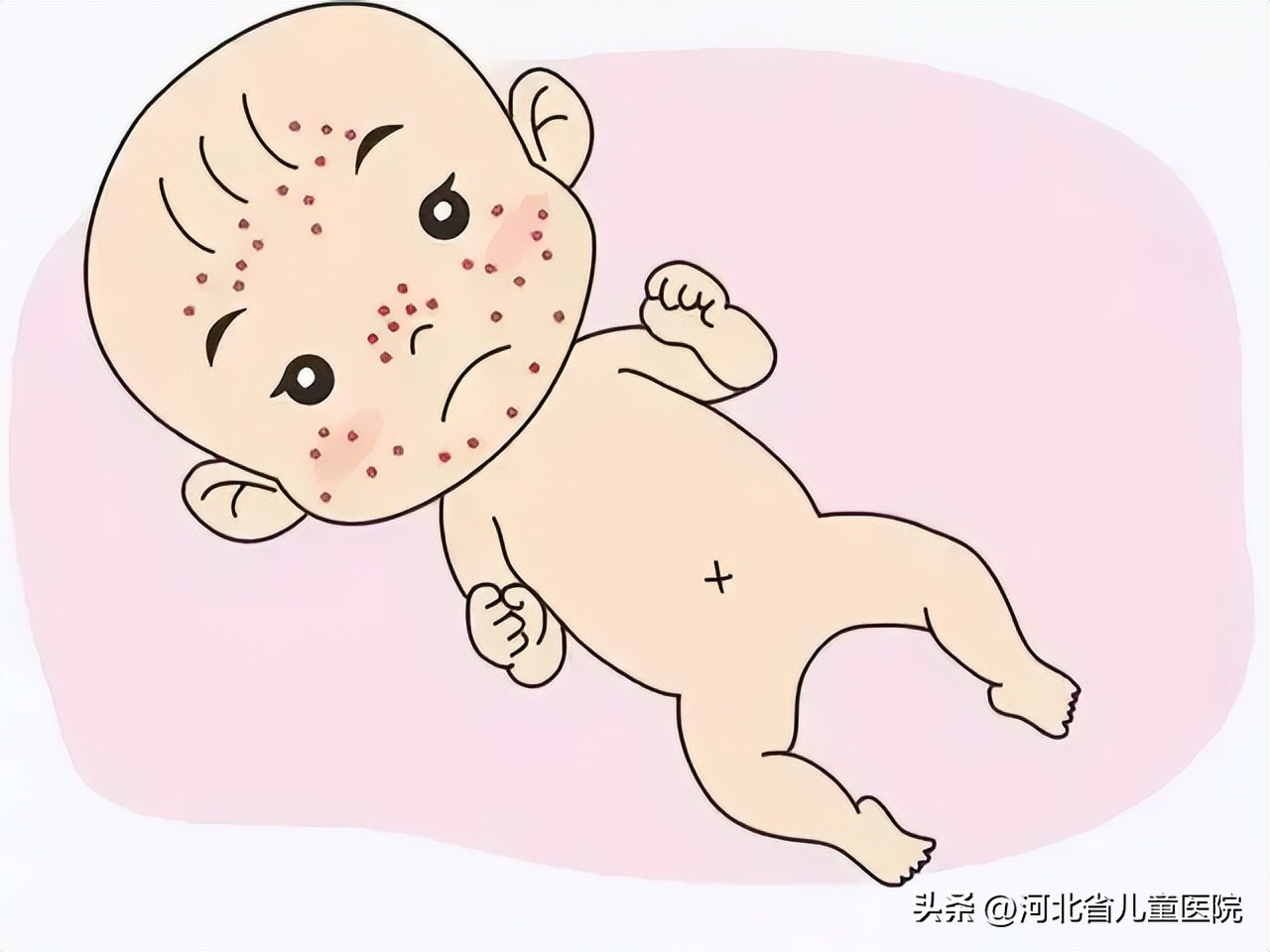 长青春痘了怎么快速消除,男孩长青春痘用什么药治